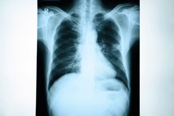 Chest x-ray image.Medical concept.