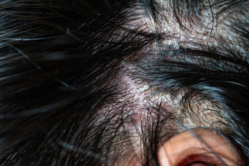 Skin diseases, on the scalp ,Woman with dandruff in her dark hair - obrazy, fototapety, plakaty
