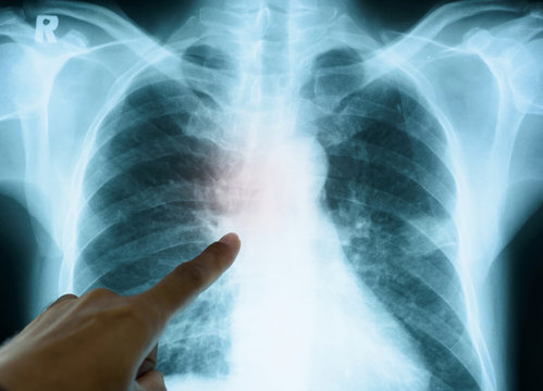 Close up doctor hand pointing x-ray image of human chest for a medical diagnosis.