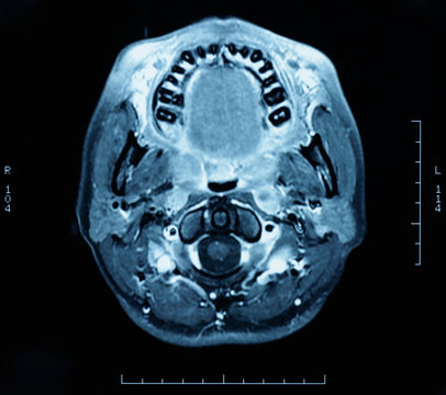 Computer tomography skull image. Radiology image for medical treatment.
