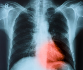 Chest x-ray and red point injury.Medical treatment concept
