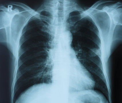 X-ray image film of human chest for a medical diagnosis on the light box