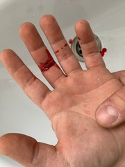 A cut on a man's hand. The damaged surface of the skin. The blood on his hand. Hand of blood...