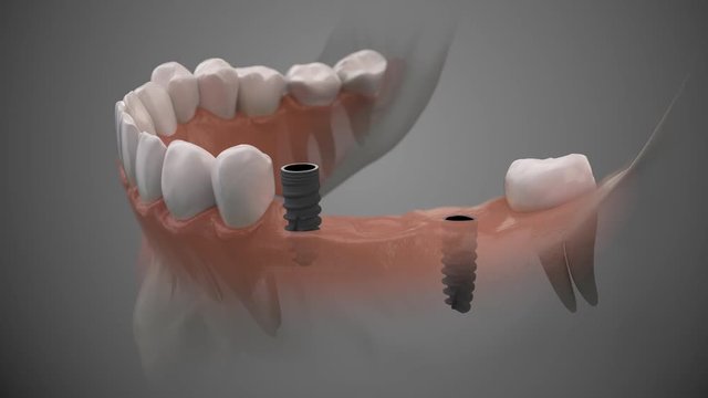 Tooth bridge human implant. Dental prosthetic innovation. 3d animation of installation process. 4k