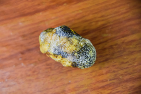 Large Gallstone, Gall Bladder Stone. The Result Of Gallstones