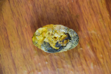 Large gallstone, Gall bladder stone. The result of gallstones
