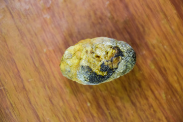 Large gallstone, Gall bladder stone. The result of gallstones