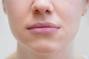 Face of a caucasian girl close-up Face, caucasian, girl, closeup, herpes, lips, woman,