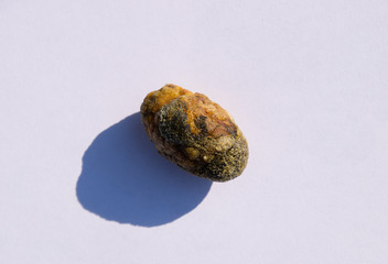 Naklejka premium Stone of gallbladder. The result of gallstones. A calculus of heterogeneous composition.