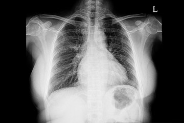 chest xray of the patient with mild cardiomegaly