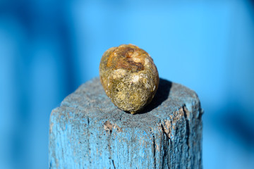 Gall bladder stone. Calculus of heterogeneous composition