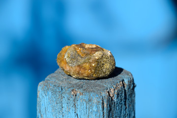 Gall bladder stone. Calculus of heterogeneous composition