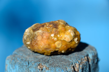 Gall bladder stone. Calculus of heterogeneous composition