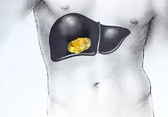 stone in the liver, schematic image, a large gallstone, the result of gallstones.