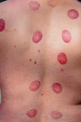 Skin after traditional cupping therapy. Vertical image.