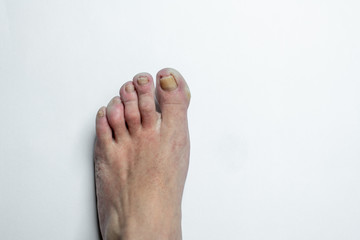 ill, injured toe, yellow nails in a damaged, feminine foot isolated on a white background
