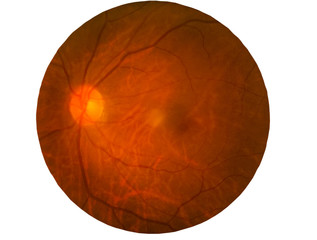 Retina of diabetes , diabates retinopathy,photo Medical Retina Abnormal isolated on white background.Saved with clipping path