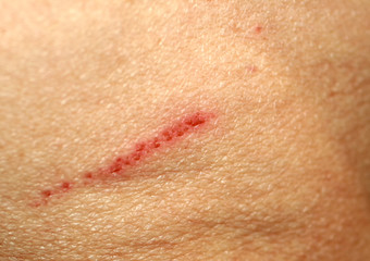 Wound cut on the skin. Abrasion on human skin.