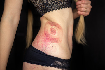  A bruise on the body of a young girl, a woman with extensive hematoma after a massage, isolated on...