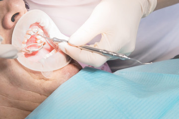 Extreme macro closeup of an open male human mouth showing the preparation for the installation of...