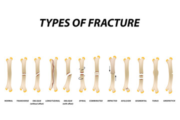 Types of fracture. Fracture bone set. Infographics. Vector illustration on isolated background.