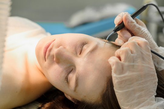 Medical treatment removal of birthmark from female patient's face. Female dermatologist surgeon using professional electrocautery for removing mole. Radio wave electrocoagulation remove method.