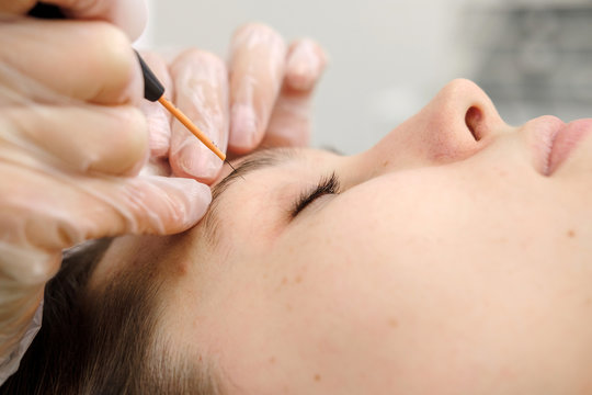 Medical treatment removal of birthmark from female patient's face. Female dermatologist surgeon using electrocautery for removing mole. Radio wave electrocoagulation remove method. Close up