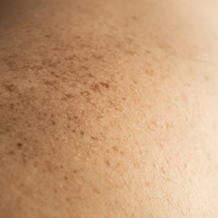 Close up detail of the bare skin on a man back with scattered moles and freckles. Checking benign moles. Sun effect on skin. Birthmarks on skin