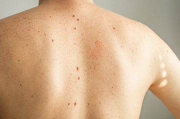 Close up detail of the bare skin on a man back with scattered moles and freckles. Checking benign moles. Sun effect on skin. Birthmarks on skin