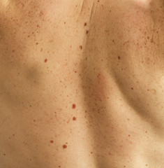 Close up detail of the bare skin on a man back with scattered moles and freckles. Checking benign moles. Sun effect on skin. Birthmarks on skin