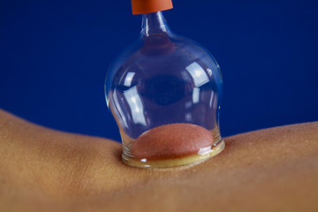 Cupping therapy as a form of alternative chinese medicine