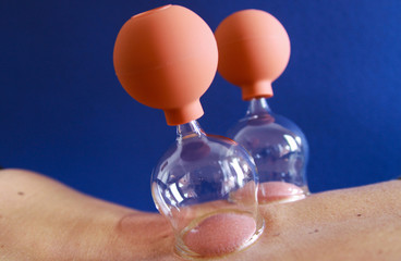 Cupping therapy as a form of alternative chinese medicine: Close up of glass cup with balloon and...