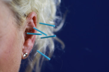 Close up of human female ear with blue needles: Ear acupuncture as a form of alternative chinese medicine