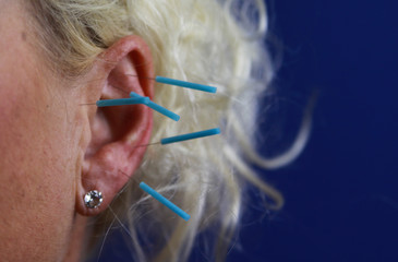Close up of human female ear with blue needles: Ear acupuncture as a form of alternative chinese...