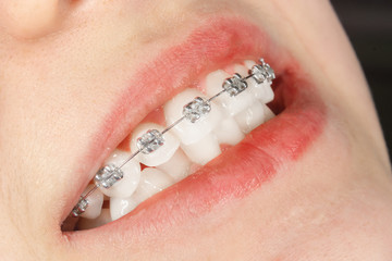 dental treatment by an orthodontist with dental braces. White teeth and smile close up
