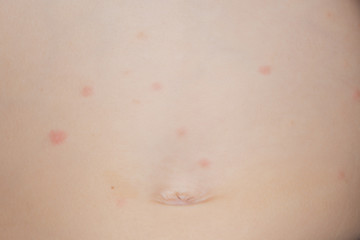 Itchy rash on the belly of a young toddler