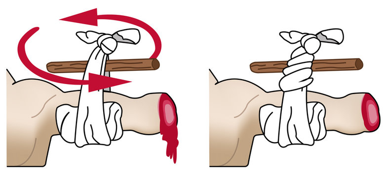 Torniquete amputaci&oacute;n brazo