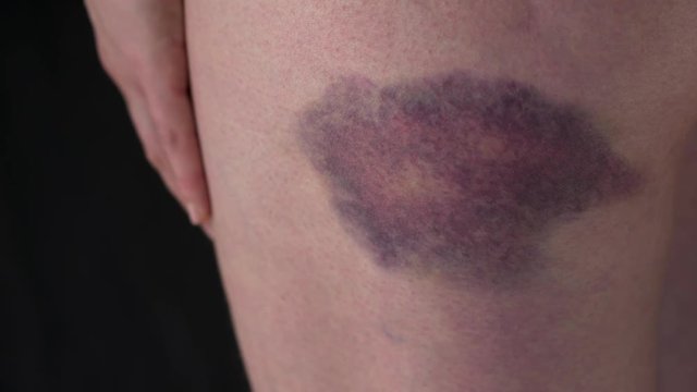 Bruise On Female Body