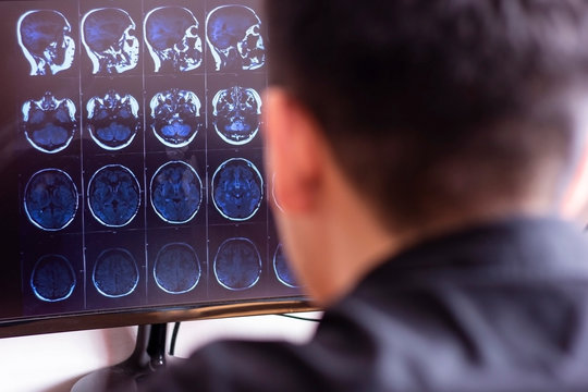 Doctor radiologist in hospital looking at x-ray mri scan of brain, head and skull ct scanning on computer screen