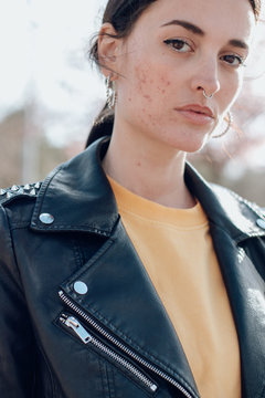 Portrait of young woman with acne