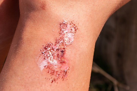Verletzung unter dem Knie 