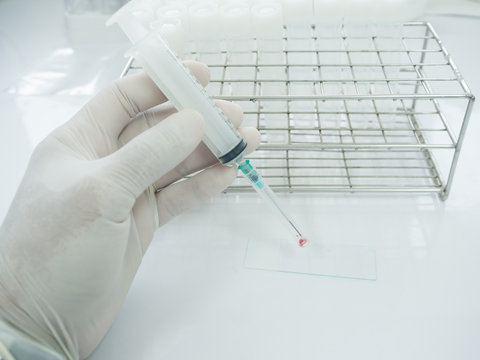 Close Up Doctor Hand Holding Syringe During Smear Fine Needle Aspiration (FNA) From Specimen Breast.Non Gynae Specimen For Cytology And Pathology Diagnosis. Medical Treatment Concept.