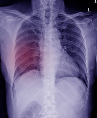 Multiple  fracture ribs x-ray chest.Blue tone process.