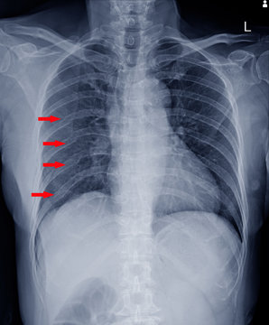  x-ray chest.finding Multiple  fracture ribs on red arrows mark.