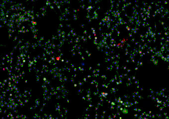 Real fluorescence microscopic view of cancer cells - human melanoma