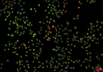 Real fluorescence microscopic view of cancer cells - human melanoma
