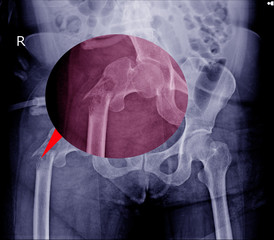 Borken femur on red color mark.medical x-ray