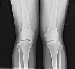 X-ray both knee showing normal joint.
