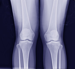 standing both knee views x-ray show normal joint