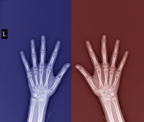 film x-ray both hand AP : show normal human's hands on black background (isolated)